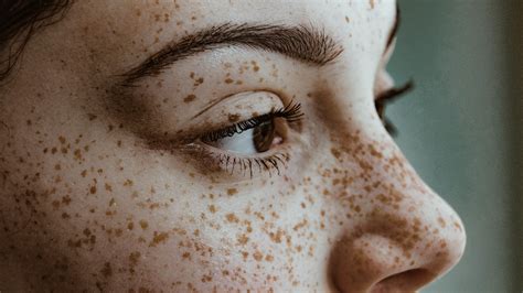 What Causes Brown Freckles